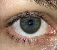 Kuvahaun tulos haulle Kayser-Fleischer