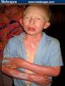 Genetic Disorder Research - Albinism