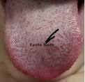 Burning Mouth / Burning Tongue Syndrome What is burning mouth ... 