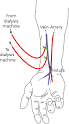 Hemodialysis - Wikipedia, the free encyclopedia