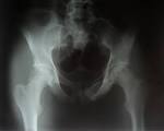 <b>de la cabeza femoral</b> en