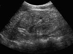 <b>Autosomal Recessive Polycystic</b>