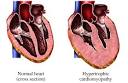 HYPERTROPHIC CARDIOMYOPATHY - HYPERTROPHIC CARDIOMYOPATHY ...