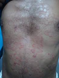 Image result for tinea corporis