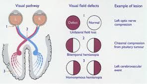 Image result for Homonymous hemianopsia