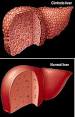 a <b>liver</b> with <b>cirrhosis</b>.