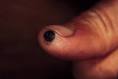 Blisters