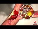 Activase
