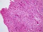 <b>Chondroblastoma</b> - PORTNotes -