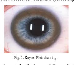 Kuvahaun tulos haulle Kayser-Fleischer