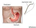 Stomach acid test