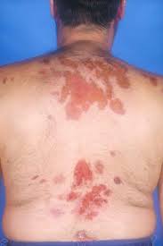 Attēlu rezultāti vaicājumam “Pemphigus borealis”