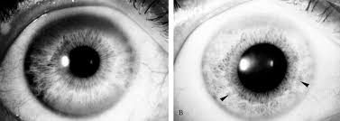 Kuvahaun tulos haulle Kayser-Fleischer