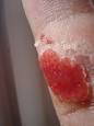 Granulation tissue - Wikipedia, the free encyclopedia