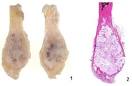 Bone: Chondrosarcoma