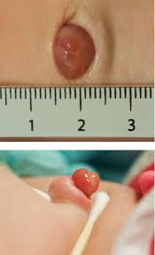 Attēlu rezultāti vaicājumam “Diderma umbilicatum young”