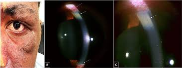 Kuvahaun tulos haulle Kayser-Fleischer