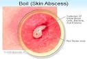 Boils (Skin Abscesses) Information, Causes, Symptoms, Treatment ...