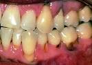 Recession And <b>Root Caries</b>