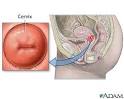 Special-care pregnancies - Cervical Insufficiency