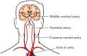 Hypoxic Ischemic Encephalopathy