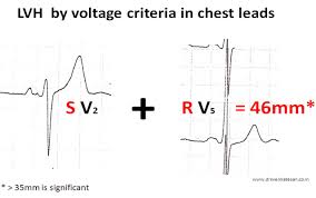 Image result for  ^ L V [ h    