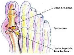  Gout Remedies