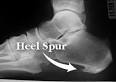 Heel Bone Spur