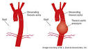 Aortic Aneurysm   University of Michigan Cardiac Surgery
