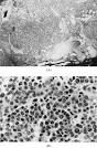 rare typical <b>plasmacytes</b>