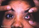 <b>Microphthalmos</b>