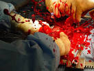 Open Heart Surgery Picture