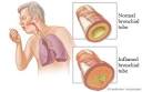 Chronic Bronchitis - Health.