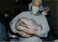 Ovarian mucinous cyst adenoma