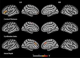 Attēlu rezultāti vaicājumam “Perichaena corticalis sessile”