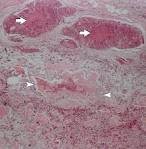 Carcinosarcoma of the breast