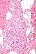 Ganglion - Wikipedia, the free encyclopedia