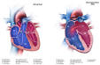 CDC - Congenital <b>Heart Defects</b>, Facts about <b>Atrial Septal Defect</b>