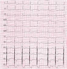 Image result for  ^ L V [ h    