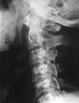 <b>Ossification</b> of the <b>posterior</b>