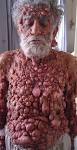 CHEST: neurofibromatosis