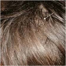 Attēlu rezultāti vaicājumam “Pediculus humanus capitis”