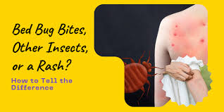 Image result for bed bug bites