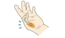 What is a Trigger Thumb & How to Address Thumb Discomfort ...