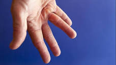 Mayo Clinic Q and A: Dupuytren's contracture - Mayo Clinic News ...