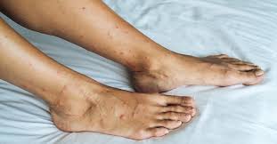 Image result for bed bug bites