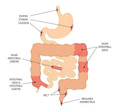 Image result for boala crohn si schizofrenie paranoida