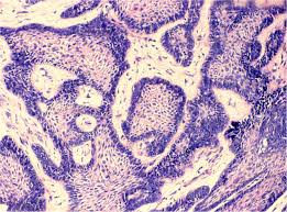 Attēlu rezultāti vaicājumam “Odontoschisma denudatum cells”