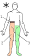 <b>Brown</b>-<b>Séquard syndrome</b>