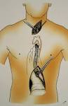 Esophagectomy - open. Causes, symptoms, treatment Esophagectomy - open